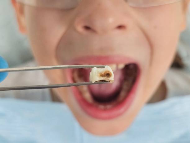 Best Emergency Root Canal Treatment in Oakley, UT
